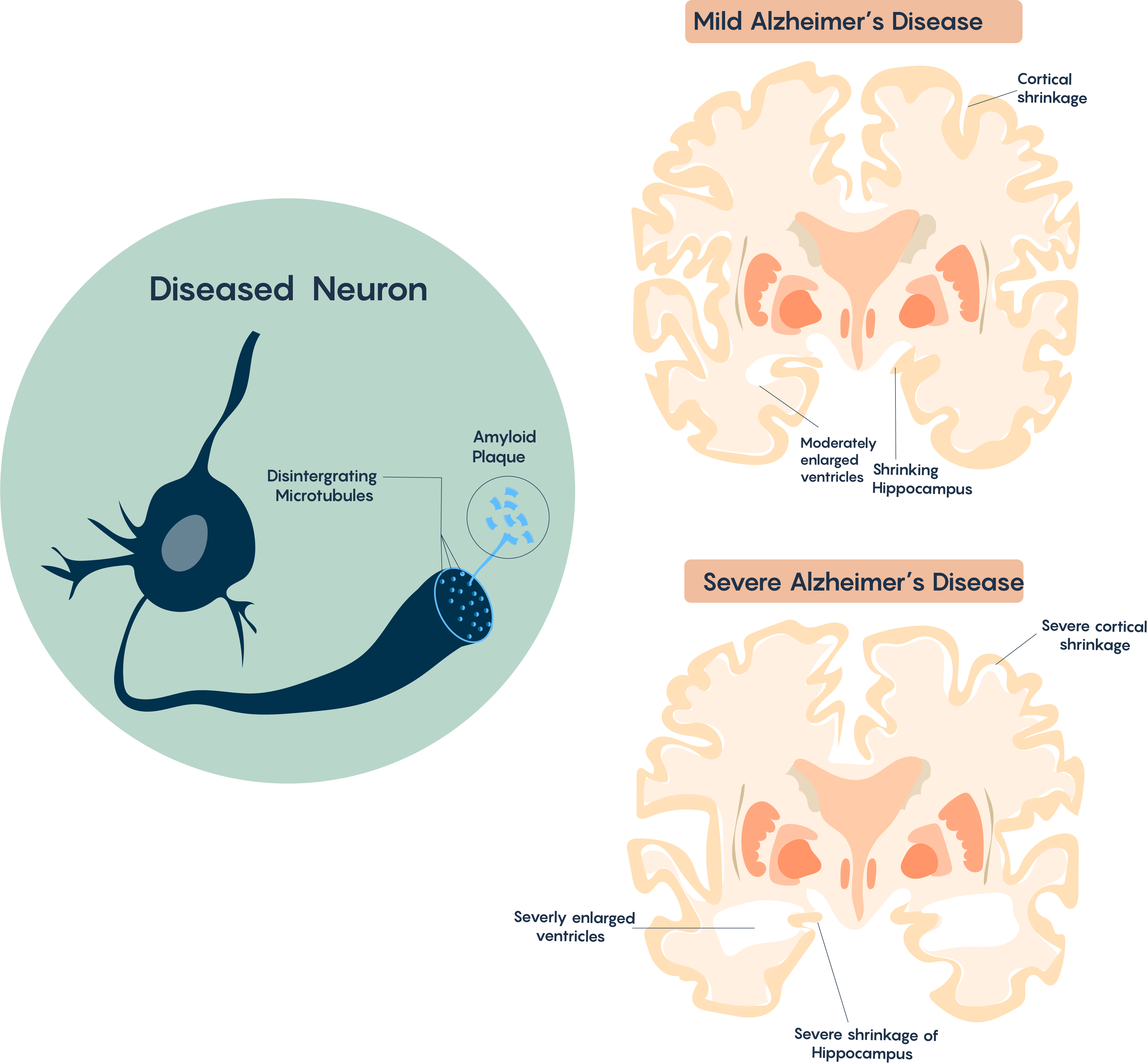 Shrinkage and loss of specific regions of the brain.