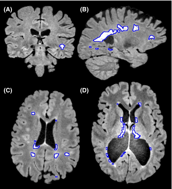MRI images showing white hyperintensities in different areas of the brain of an individual experiencing symptoms of multiple sclerosis. (A) A coronal slice showing a lesion in peripheral white matter. (B) A sagittal slice showing large periventricular lesions. (C) An axial slice showing both periventricular and peripheral white matter lesions. (D) A case where severe atrophy caused midline false positives to not be removed, as they were further from midline than expected.
